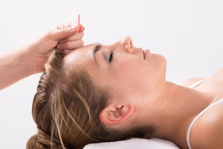 Woman receiving acupuncture treatment on forehead, lying down with eyes closed, in a serene environment